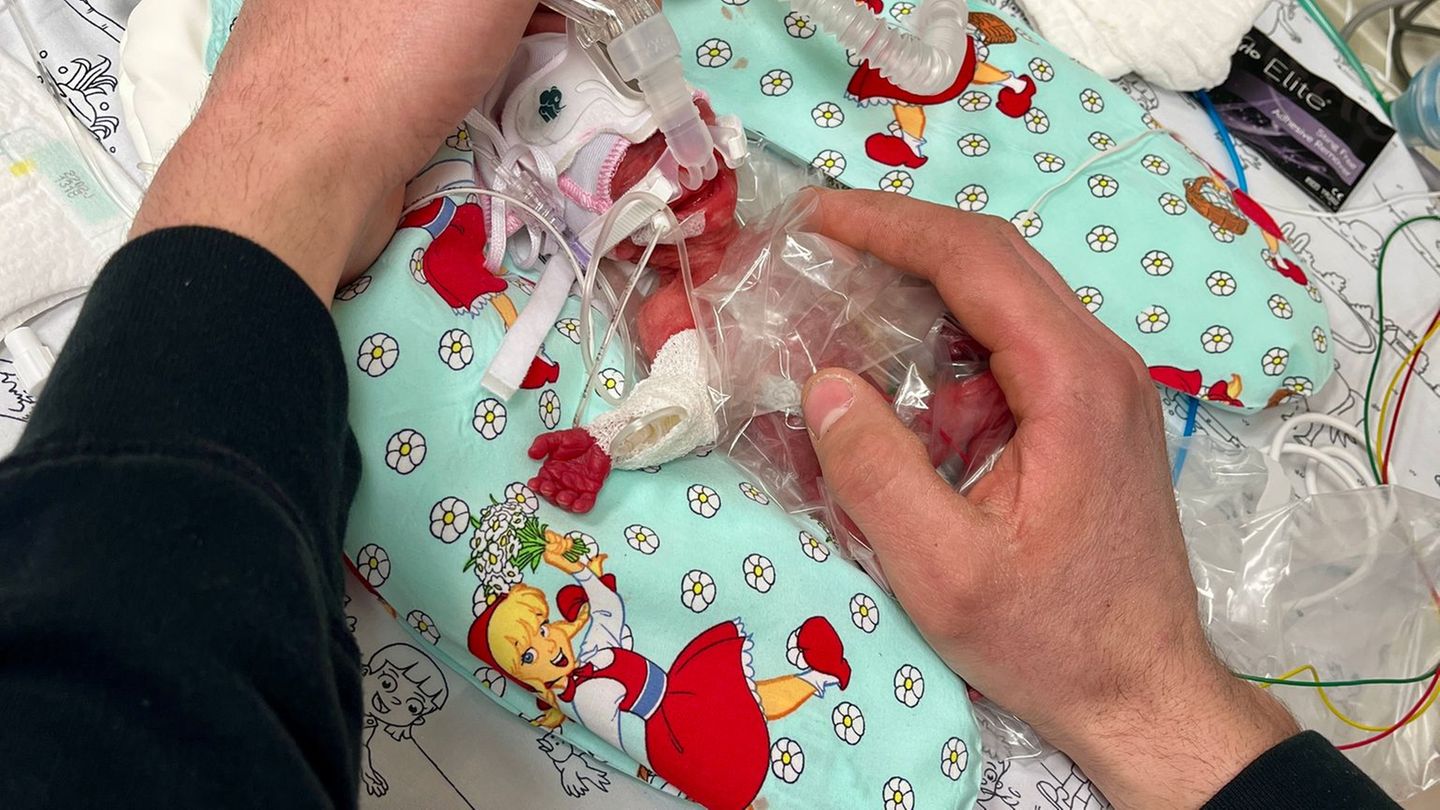 Passau-Ein-kleines-Wunder-Baby-berlebt-trotz-265-Gramm-Geburtsgewicht