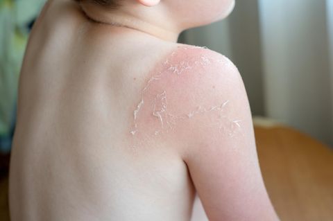 Nach einem schwerem Sonnenbrand während einer Klassenfahrt auf Sylt kommt ein Schulkind ins Krankenhaus (Symbolfoto)