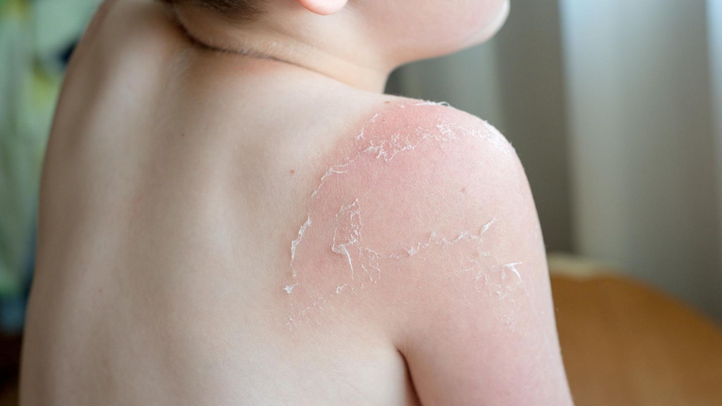 Nach einem schwerem Sonnenbrand während einer Klassenfahrt auf Sylt kommt ein Schulkind ins Krankenhaus (Symbolfoto)