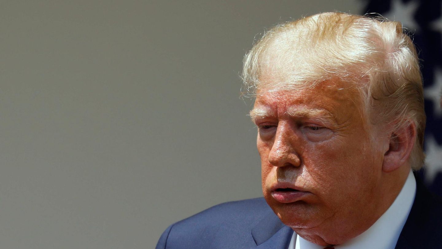 Donald Trump has chronic disease of the leg veins