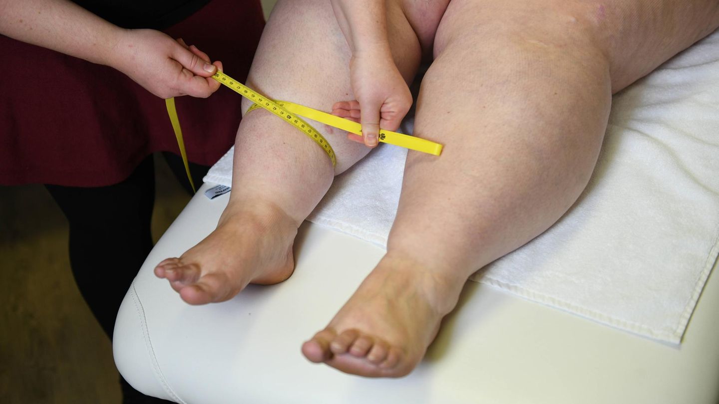 Lipedema: Fat suctions will pay the health insurance company in the future