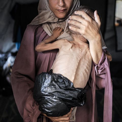 Mother with a malfunished child in Gaza