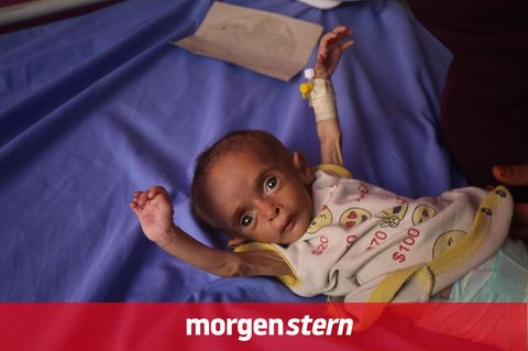 Ein Kind mit Unterernährung in Gaza