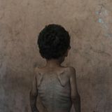 Yazan Abu Ful, ein zweijähriges unterernährtes Kind, sitzt für ein Foto im Haus seiner Familie im Flüchtlingslager Shati. Israel bestreitet, dass es im Gazastreifen eine Hungerkatastrophe gibt und spricht stattdessen von einer "Kampagne" der Hamas