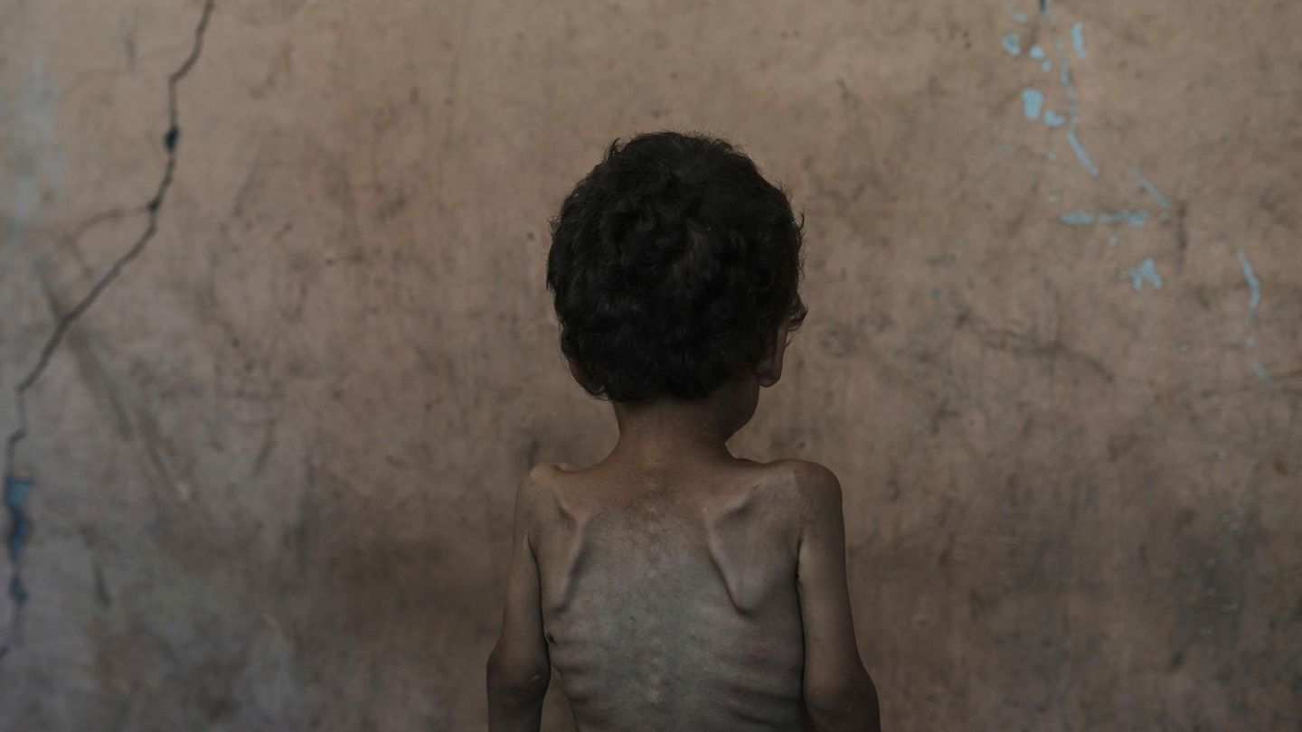 Yazan Abu Ful, ein zweijähriges unterernährtes Kind, sitzt für ein Foto im Haus seiner Familie im Flüchtlingslager Shati. Israel bestreitet, dass es im Gazastreifen eine Hungerkatastrophe gibt und spricht stattdessen von einer "Kampagne" der Hamas