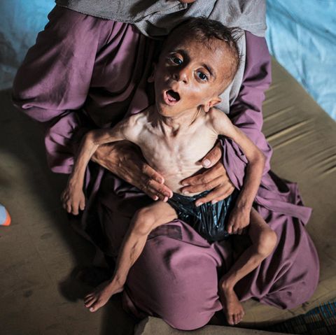 Muhammad is 18 months old, only skin and bone, six kilograms light. Instead of a diaper, it wears a plastic bag. The physiotherapy that the little one received against his developmental disorder can no longer take place. Mother Hedaya, 31, has no baby food, lives with her badly malnourished son in a tent in Gaza City, which photographer Ahmed al-Arini reminded of a grave. Muhammad is just one of thousands of Palestinian children who share this fate - a face of this war, the end of which he may no longer experience