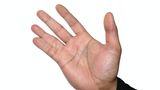 Körpermerkmale: Hand mit zusammengewachsenen Fingern