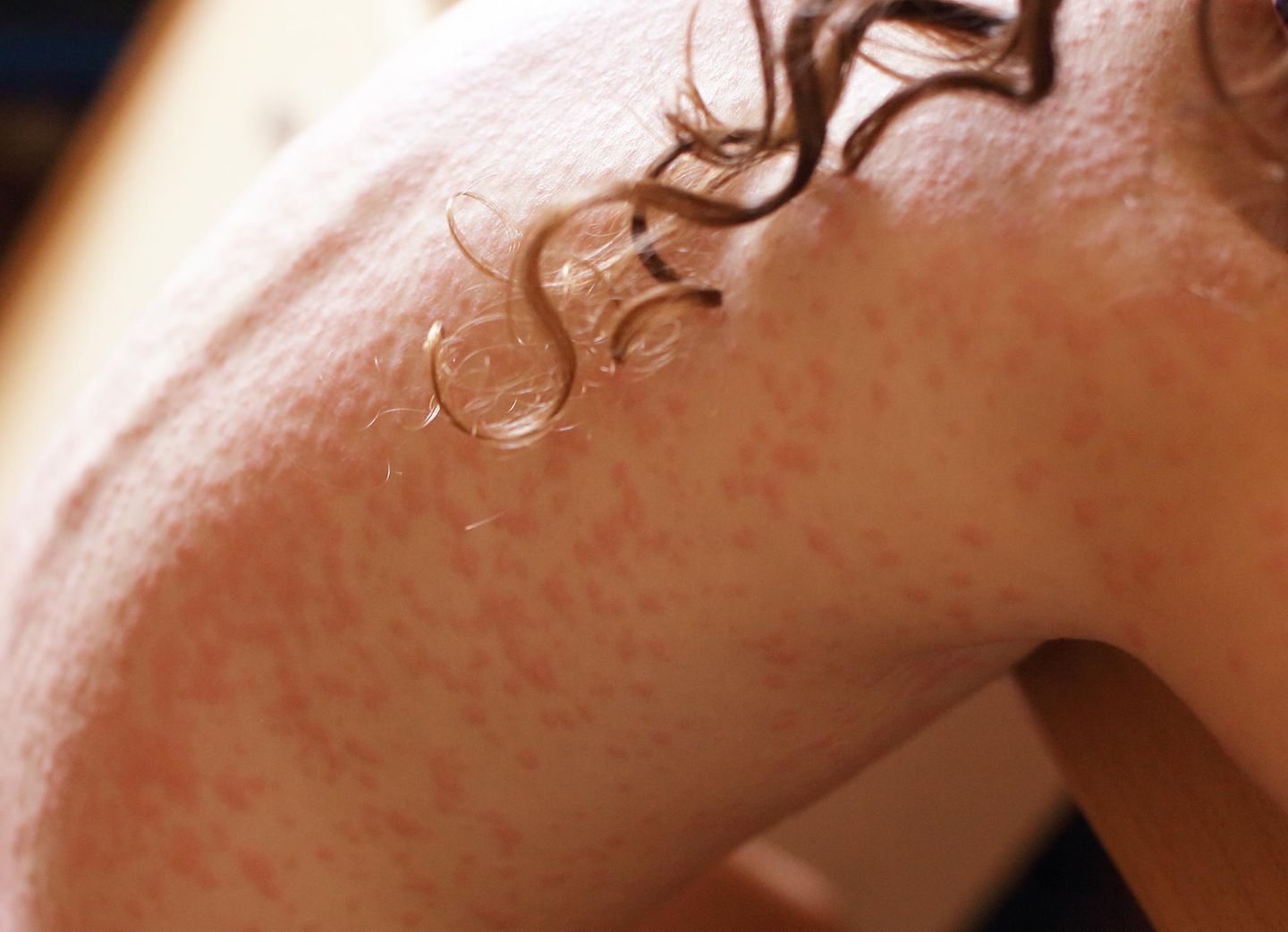 Allergie: Heftiger Hautausschlag auf dem Rücken eines Mädchens