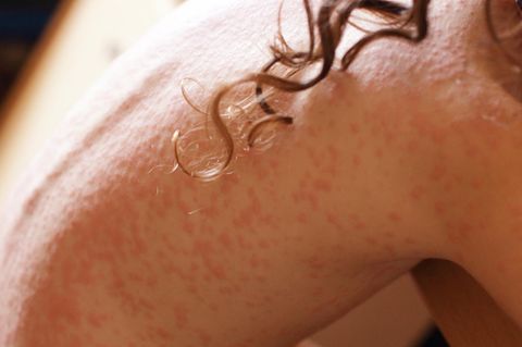 Allergie: Heftiger Hautausschlag auf dem Rücken eines Mädchens