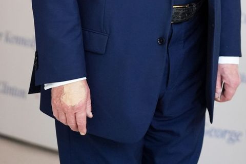 Schminkflecken an Donald Trumps Hand