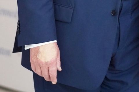 Auf Donald Trumps rechter Hand ist ein großer Make-Up Fleck.