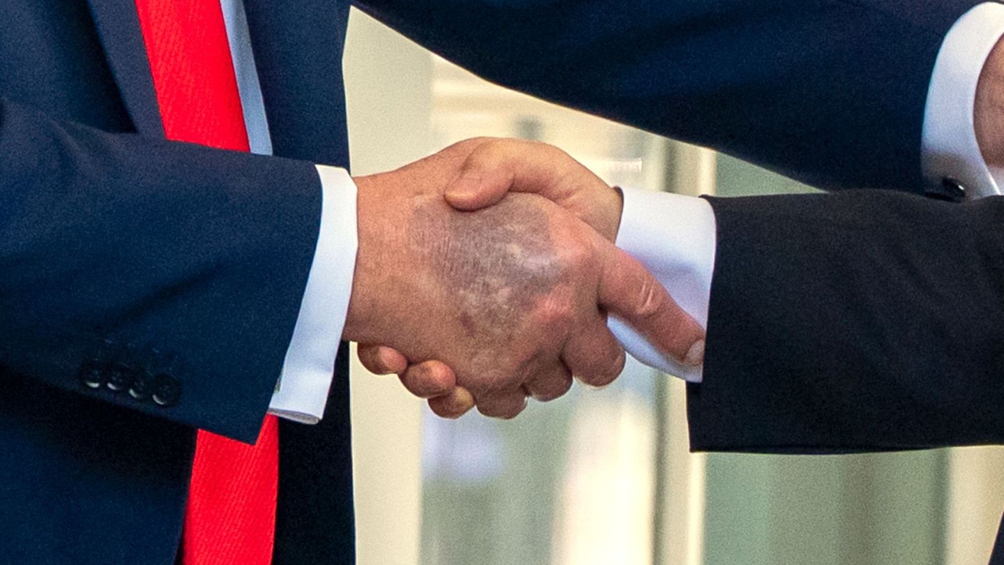Health of the US President: Trump once again photographed with bruising on the hand