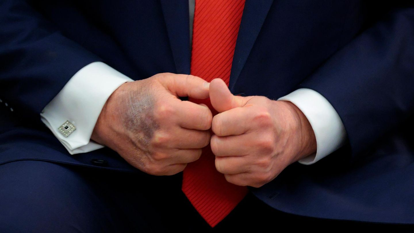 Donald Trump once again photographed with bruising on the hand