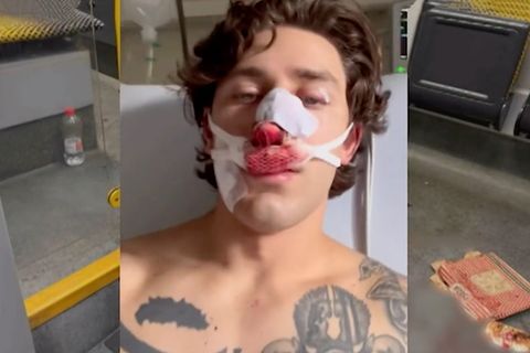 Ein junger Mann schaut in die Kamera, Blut läuft ihm über sein unteres Gesicht.
