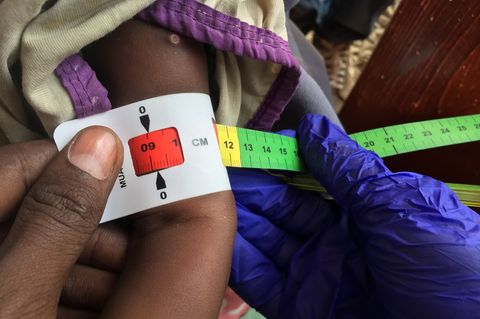 Ein Arzt misst im Sudan den Armumfang eines schwer unterernährten Babys (Archivbild) Foto: Eva-Maria Krafczyk/dpa