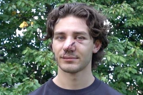 Jonathan Rudat steht mit einer großen Narbe im Gesicht vor einem Busch und gibt ein Interview.