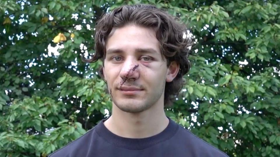 Jonathan Rudat im Interview Jonathan Rudat steht mit einer großen Narbe im Gesicht vor einem Busch und gibt ein Interview.
