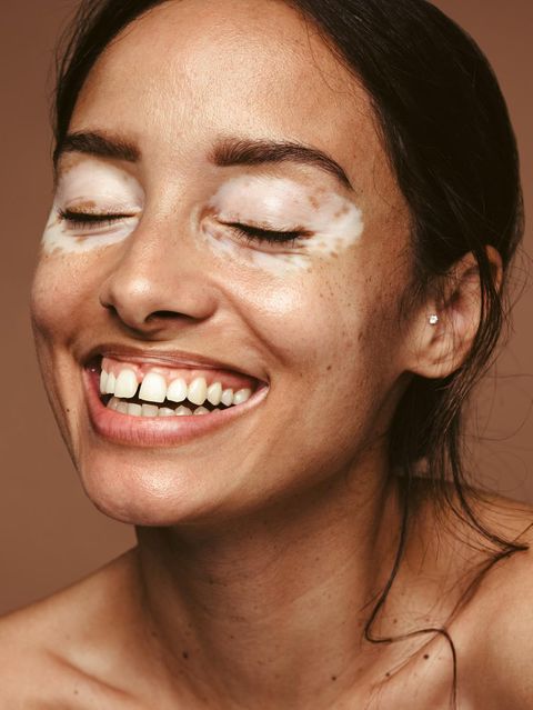 Haut: Frau mit weißen Flecken im Gesicht – Vitiligo