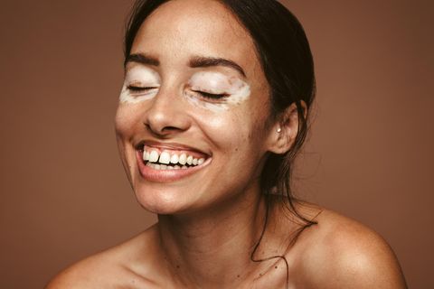 Haut: Frau mit weißen Flecken im Gesicht – Vitiligo