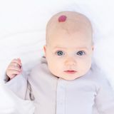 Haut: Hämangiom bei Baby