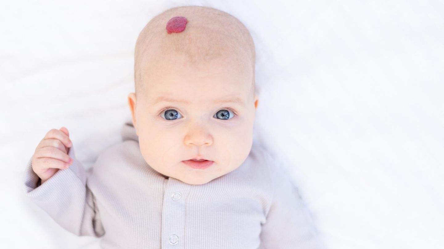 Haut: Hämangiom bei Baby Haut: Hämangiom bei Baby