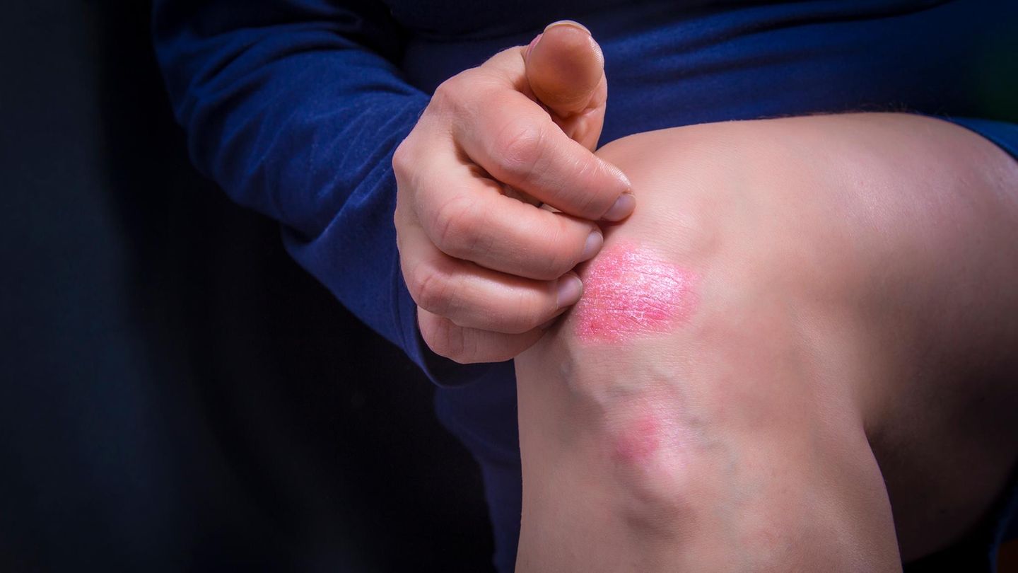 Haut: Schuppenflechte am Knie