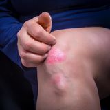 Haut: Schuppenflechte am Knie