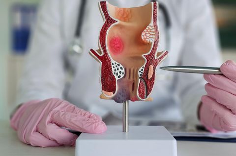 Proktologie: Arzt zeigt ein Modell des Enddarms
