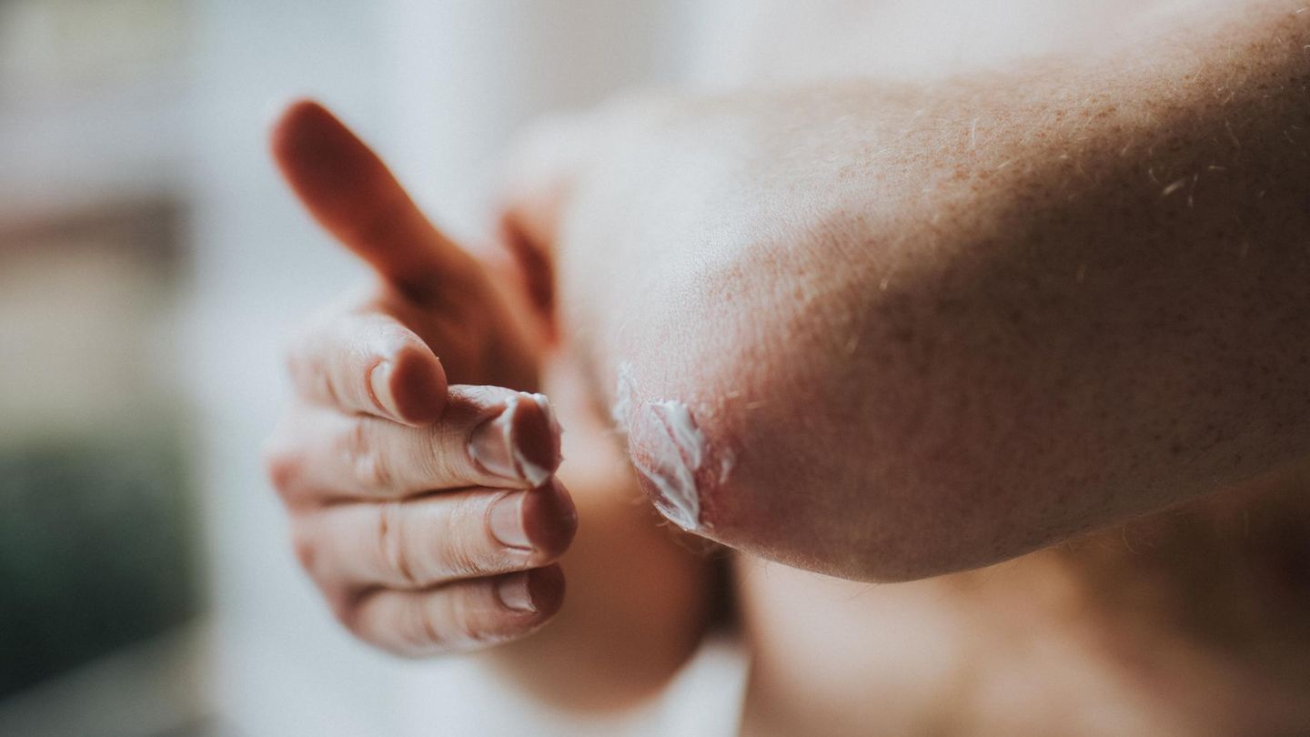 Psoriasis: Person cremt ihren Arm ein