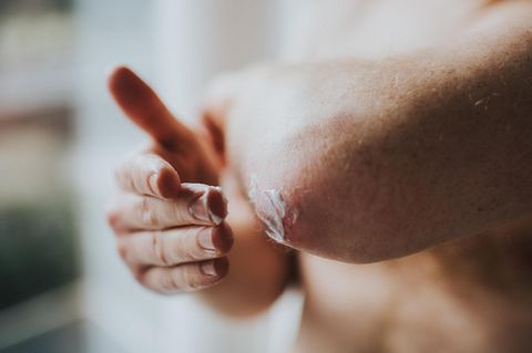 Psoriasis: Person cremt ihren Arm ein
