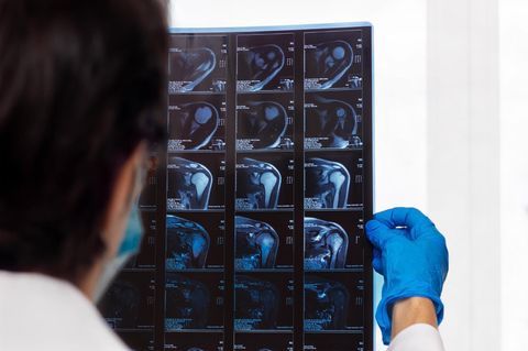 Schulterchirurgie: Arzt hält Röntgenaufnahme einer Schulter