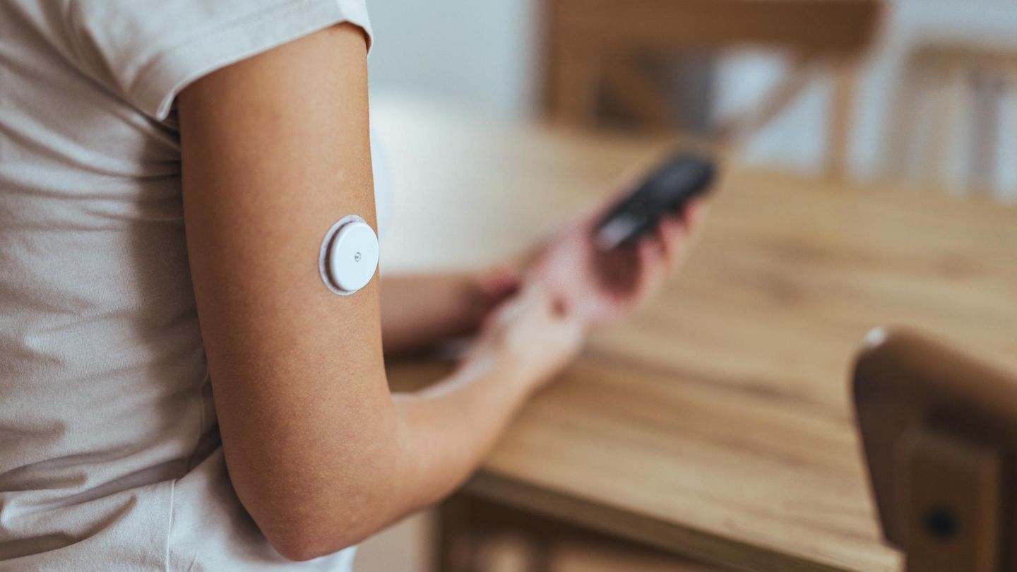 Diabetologie: Blutzuckersensor am Arm, Überwachung des Blutzuckerspiegels per Smartphone.