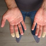 Haut: Hände mit weißen Fingerspitzen eines Patienten mit Raynaud Syndrom