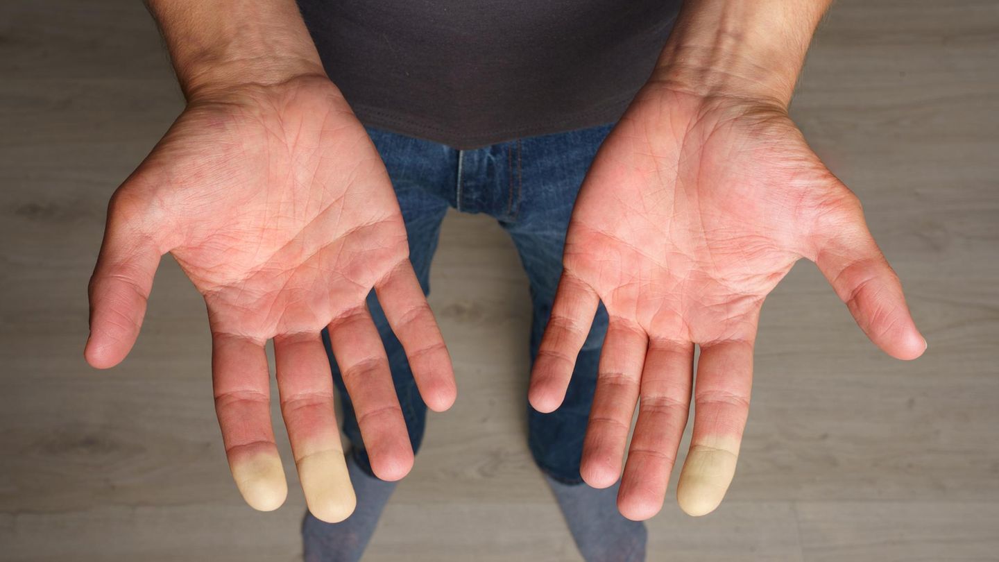Haut: Hände mit weißen Fingerspitzen eines Patienten mit Raynaud Syndrom