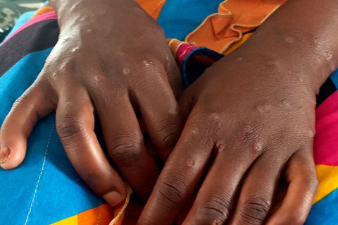 Mpox ist vor allem für kleine Kinder und immungeschwächte Menschen gefährlich (Archivbild) Foto: Janvier Barhahiga/AP/dpa