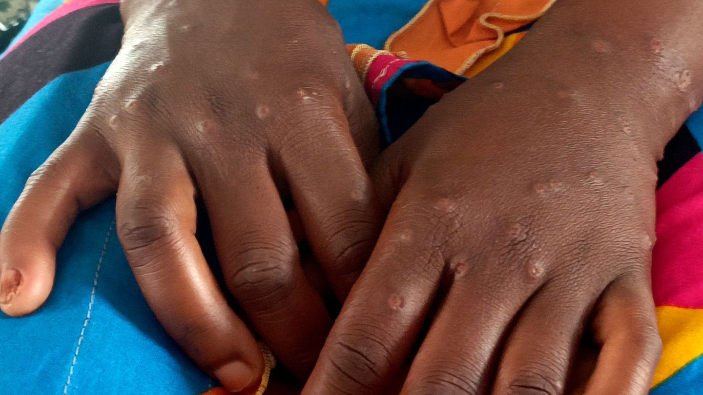 Mpox ist vor allem für kleine Kinder und immungeschwächte Menschen gefährlich (Archivbild) Foto: Janvier Barhahiga/AP/dpa