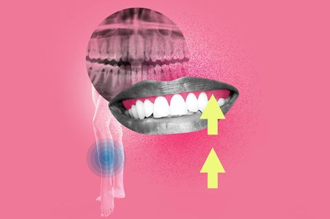 Illustration Zahnfleischentzündung: Zähne und Röntgenbild