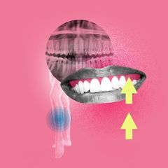 Illustration Zahnfleischentzündung: Zähne und Röntgenbild
