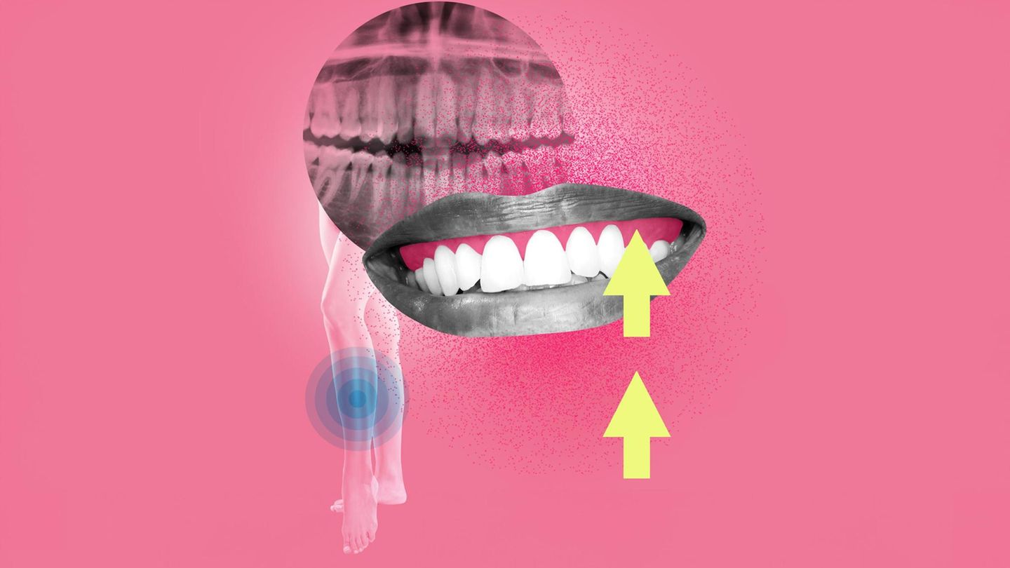 Illustration Zahnfleischentzündung: Zähne und Röntgenbild