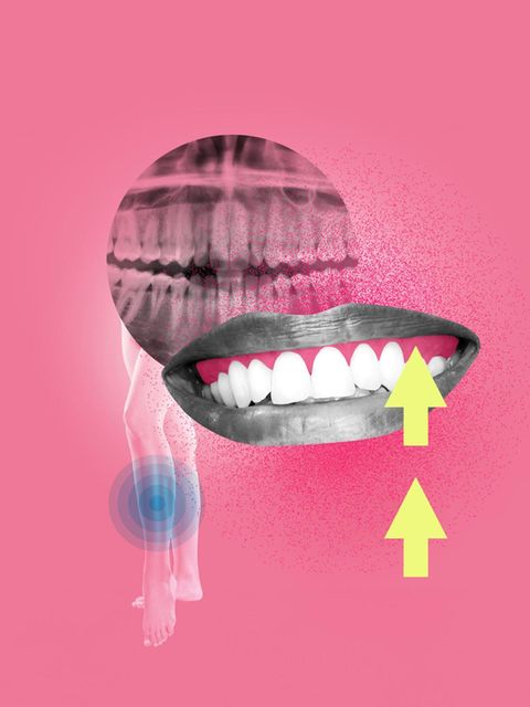 Illustration Zahnfleischentzündung: Zähne und Röntgenbild