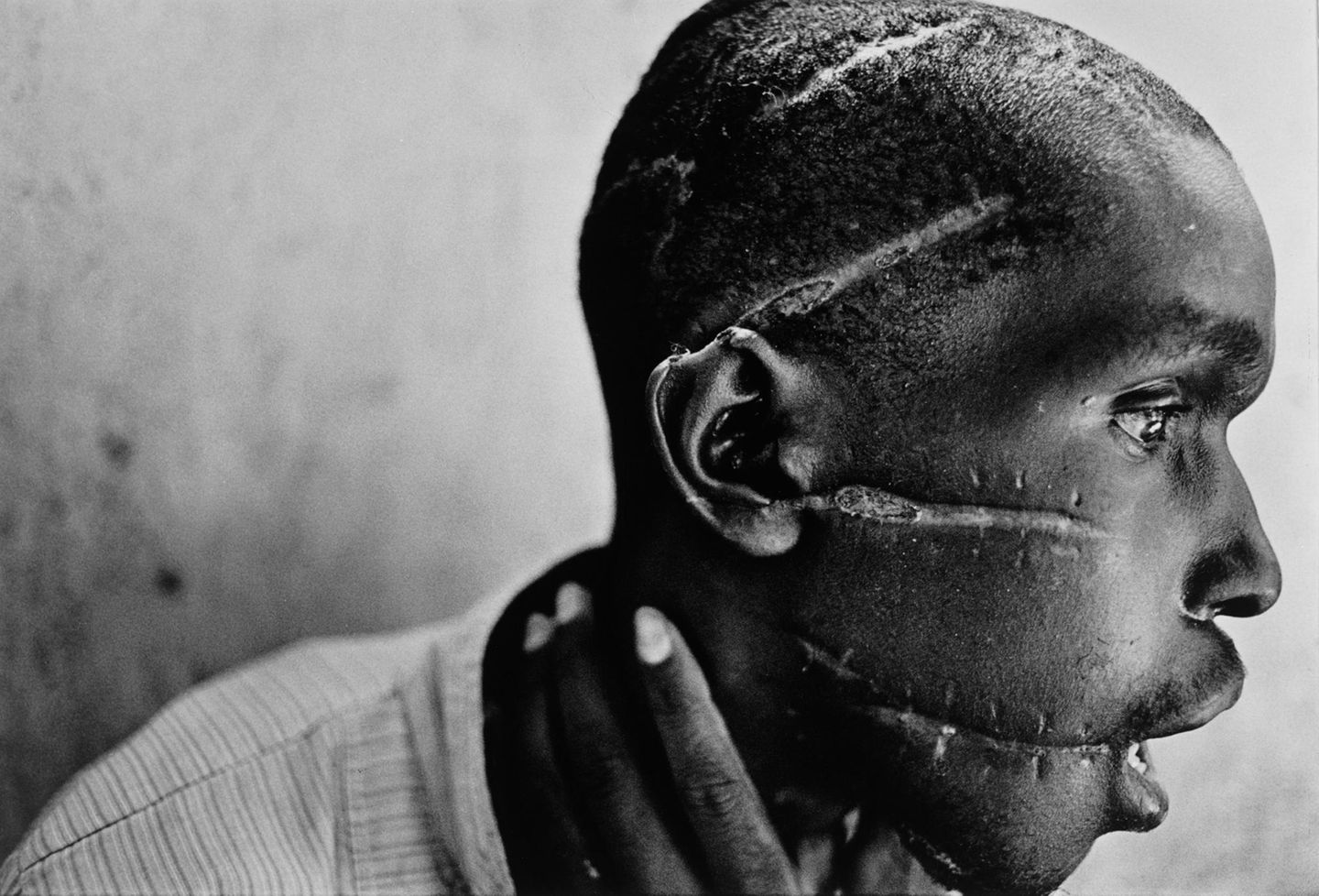 Die Narben im Gesicht dieses Mannes, der zur Volksgruppe der Hutu gehört, sind die Folge eines Macheten-Angriffs. Die Aufnahme entsteht am 1. Juni 1994 in einem Krankenhaus in der ruandischen Stadt Nyanza. In der Zeit wüten Hutu-Milizen im ganzen Land und massakrieren Hunderttausende Tutsi und Hutu, die sich mit den Tutsi solidarisch zeigen. Der Schwergezeichnete auf dem Foto war in einem Lager inhaftiert, dem Terror der Milizen schutzlos ausgesetzt