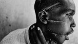 Die Narben im Gesicht dieses Mannes, der zur Volksgruppe der Hutu gehört, sind die Folge eines Macheten-Angriffs. Die Aufnahme entsteht am 1. Juni 1994 in einem Krankenhaus in der ruandischen Stadt Nyanza. In der Zeit wüten Hutu-Milizen im ganzen Land und massakrieren Hunderttausende Tutsi und Hutu, die sich mit den Tutsi solidarisch zeigen. Der Schwergezeichnete auf dem Foto war in einem Lager inhaftiert, dem Terror der Milizen schutzlos ausgesetzt