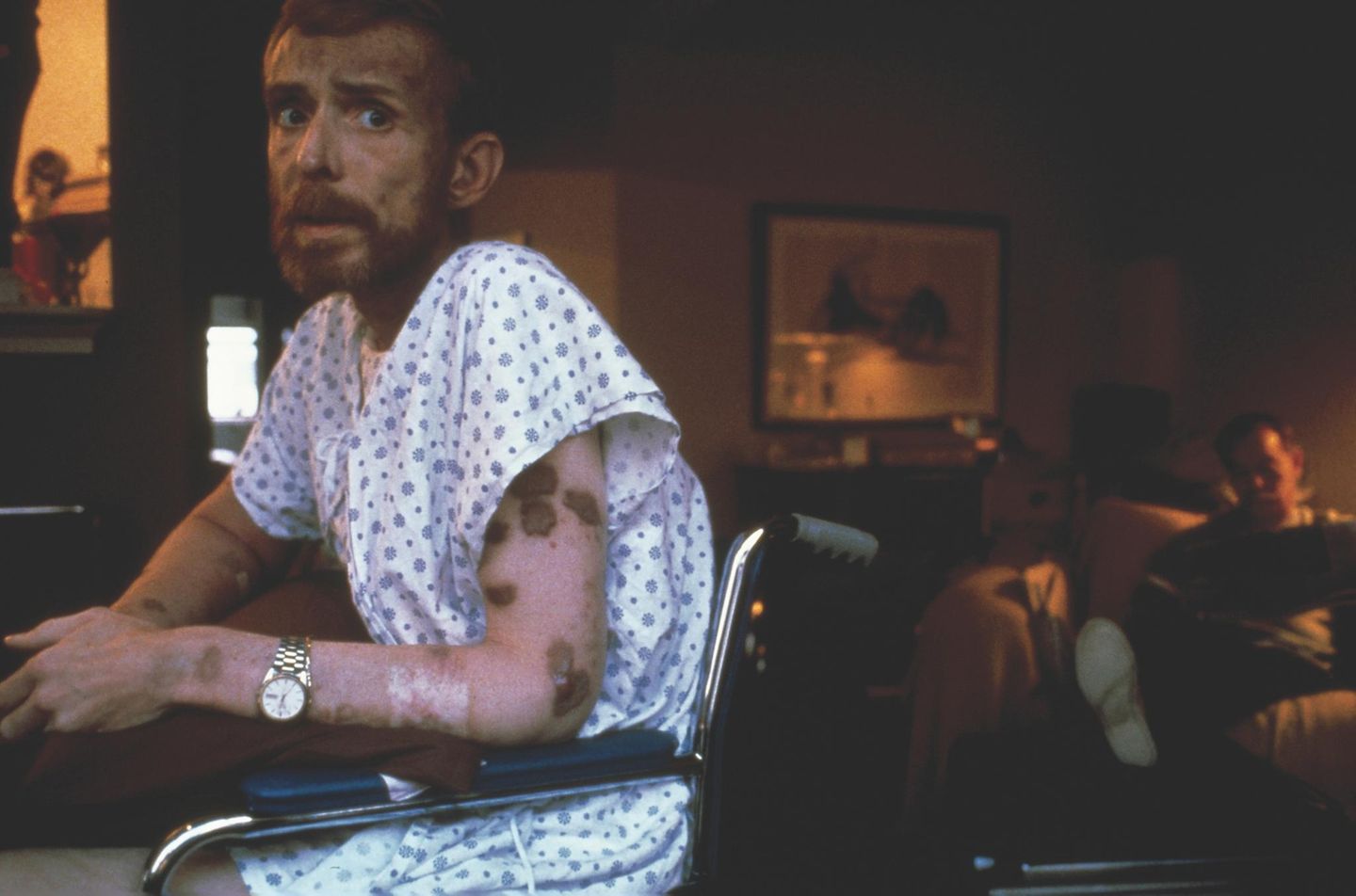 Das Bild, das die Aids-Katastrophe in den Achtzigerjahren symbolisiert. Ken Meeks Haut ist übersät mit Kaposi-Sakomen, einer Krebserkrankung, die besonders bei Menschen mit einem geschwächten Immunsystem auftritt. Er kann nur noch im Rollstuhl sitzen. Meeks stirbt wenige Tage nach der Aufnahme vom 1. September 1986