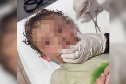 Junge klagt über Schmerzen nach Baden im Meer – Arzt entfernt Krabbe aus Ohr