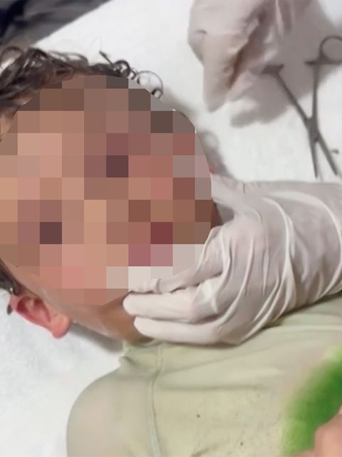 Junge klagt über Schmerzen nach Baden im Meer – Arzt entfernt Krabbe aus Ohr