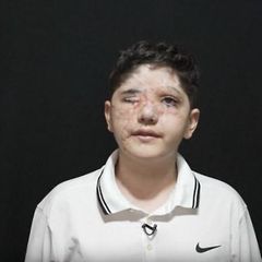 Vernarbte Gesichter von Opfern