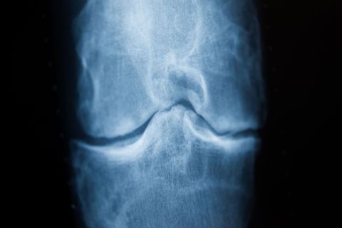 Rheuma kann sich durch Schmerzen etwa im Knie bemerkbar machen. (Archivfoto) Foto: Rolf Vennenbernd/dpa/dpa-tmn