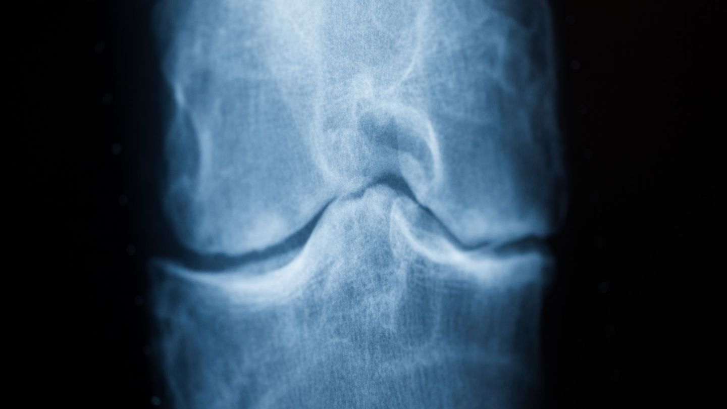 Rheuma kann sich durch Schmerzen etwa im Knie bemerkbar machen. (Archivfoto) Foto: Rolf Vennenbernd/dpa/dpa-tmn