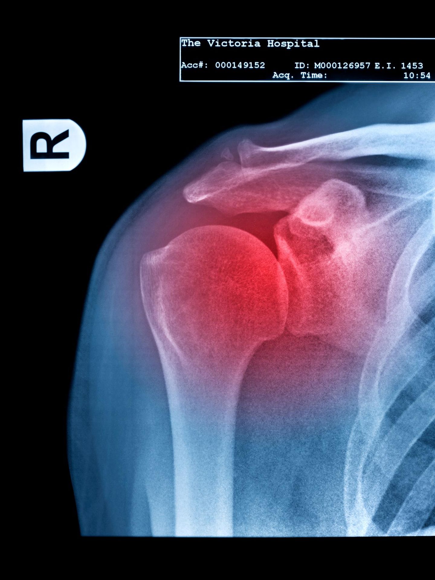 Schulterschmerz: Röntgenbild Schulter