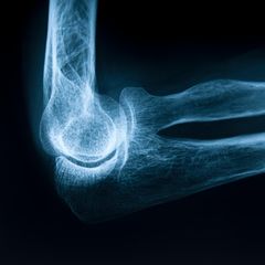 Osteoporose: Ein menschliches  Ellbogengelenk